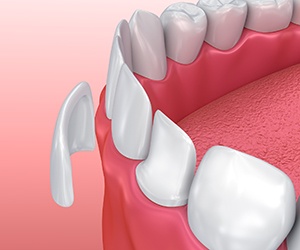 Portland Cosmetic Dentist animation of porcelain veneer placement