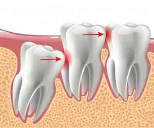 Illustration of impacted wisdom tooth