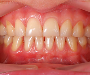 A mouth with mild periodontitis