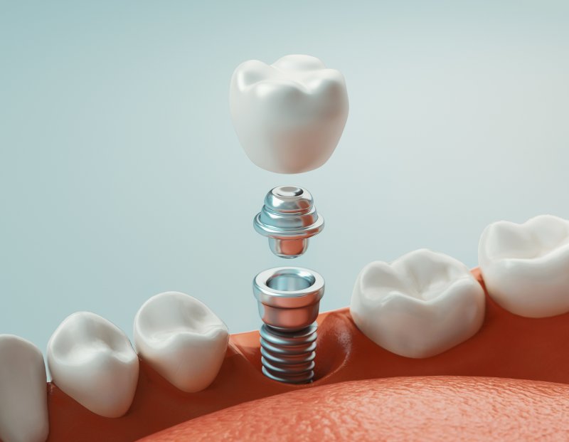 A 3D illustration of a dental implant and its metal parts